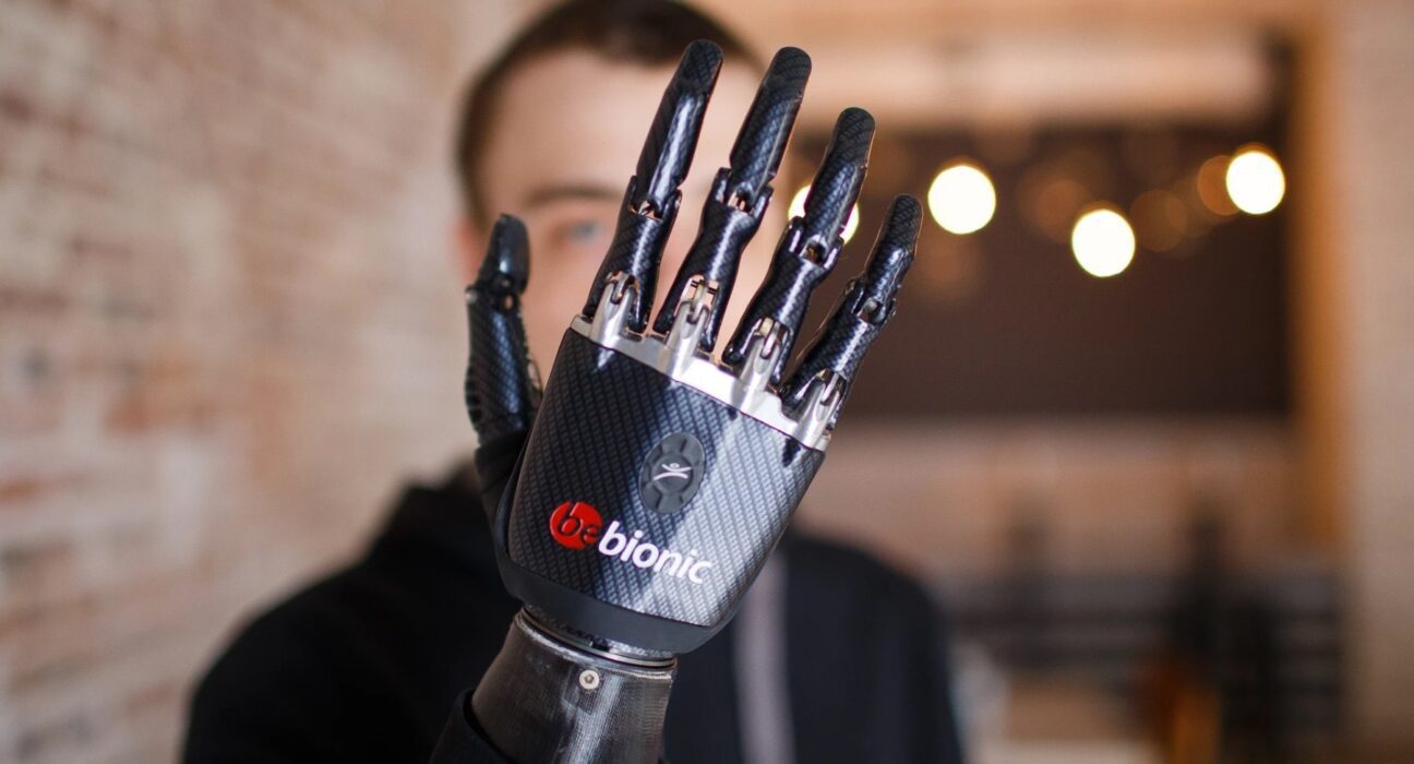 1c7c06723da4423c800fd98d02b30264 word2 Cyprus: Bionic Arm Fitted for Amputee Patient