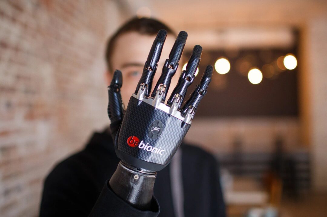 1c7c06723da4423c800fd98d02b30264 word3 Cyprus: Bionic Arm Fitted for Amputee Patient